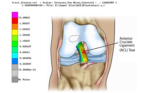 前交叉韧带仿真分析(图6)